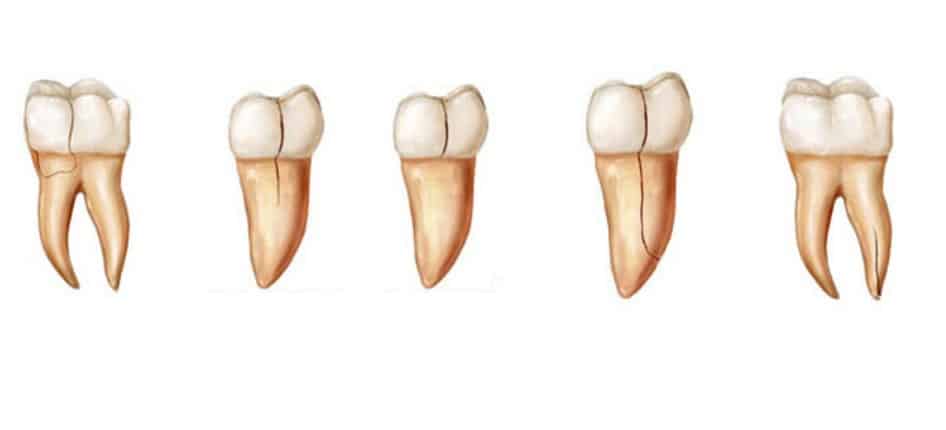 Types of dental root fractures