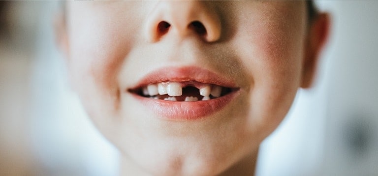 Implications of a tooth loss